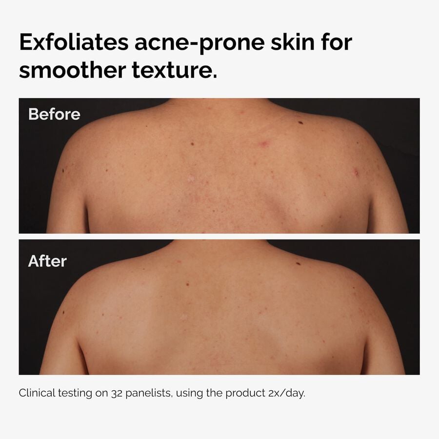 the-body-care-collection-h0 ord-salicylic-acid-body-serum-before-after-graphic-NA.jpg